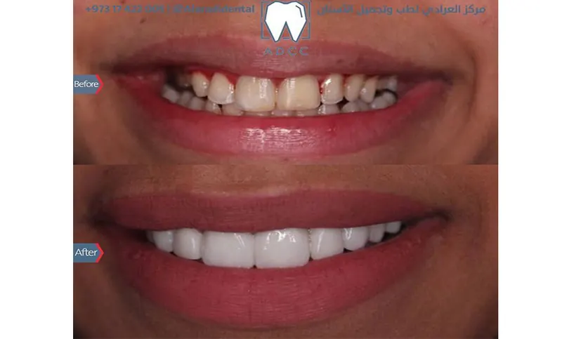 A smile with stained, uneven teeth above the same smile with even, lighter teeth