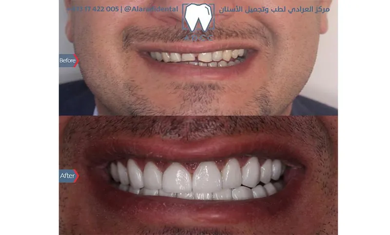 A smile with gaps and uneven teeth above the same smile with even, lighter teeth